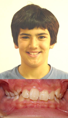 Comprehensive Treatment: Emile presented with a Class II dental malocclusion with a severe deepbite (collapsed bite) and a maxillary cant to the left. He finished with a Class I dental occlusion with the deepbite alleviated as well as the maxillary cant corrected.