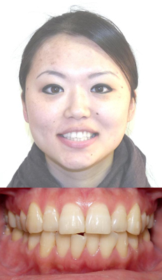 Comprehensive Treatment: Holly presented with a Class I dental malocclusion with primarily lower crowding that was pushing her lower incisor forward and causing it to be in crossbite.  She finished with a Class I dental occlusion with all crossbites corrected and great arch development.