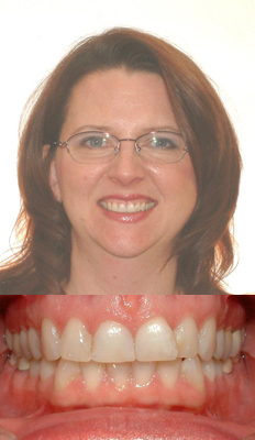 Comprehensive Treatment: Karen presented with a Class I dental malocclusion.  She was primarily a detailing case in order to properly develop her aches and to alleviate her crowding in both arches.  She finished with a Class I dental occlusion with all crowding and alleviated and good arch development.