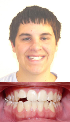 Comprehensive Treatment: Connor presented with a bilateral Class III dental malocclusion with an anterior open bite.  He was treated with orthodontic camouflage (extraction of lower 1st bicuspids) in order to establish a good bite.  He finished with a Class I canine relationship, Class III molar.