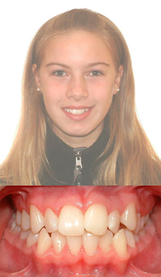 Comprehensive Treatment: Brianna presented with a Class II dental malocclusion with moderate upper and lower crowding.  She also had a posterior and anterior crossbite.  She finished with a Class I dental occlusion with all crossbites corrected.