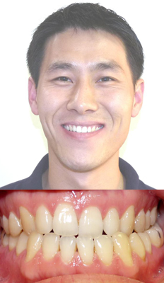 Orthognathic/Jaw Surgery: Nathan presented with a Class III dental malocclusion with a posterior crossbite on the left.  In order to balance Nathan's profile and to alleviate the crossbite, Nathan had orthognathic surgery (lower jaw was surgically retracted).  He now has a Class I dental occlusion with all crossbites relieved.