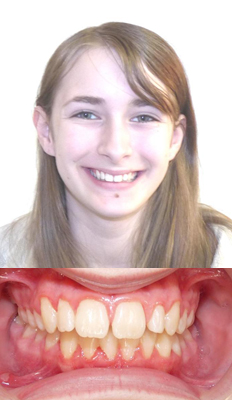 Comprehensive Treatment: Kirsten presented with a Class II Div I dental malocclusion with severe OJ and her midlines did not line up.  Her upper lateral incisor was smaller than normal.  After treatment, she finished with a Class I occlusion and her midlines coincided.  Her lateral incisor was built up to blend in nicely with the anterior esthetic zone.