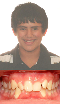 Comprehensive Treatment: Anthony presented with a Class II dental malocclusion with a severe deepbite and moderate upper and lower crowding.  His upper teeth were also tipped back.  He finished with a Class I dental occlusion with the deep bite and crowding corrected.