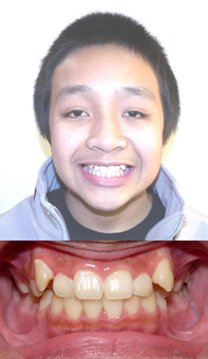 Comprehensive Treatment: Eligio presented with a full step Class II dental malocclusion.  As can be seen from the photos, his upper canines were completely blocked out of the upper arch.  He finished with a Class I dental occlusion and the canines were brought into the arch without the need of extractions.  This was done to preserve a balance profile and smile.