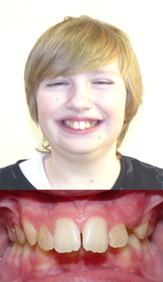 Comprehensive Treatment: Wolf presented with a Class II Div I dental malocclusion with severely protruded and proclined upper teeth. He also presented with a deep bite.  He finished with a Class I dental occlusion with proper OJ and OB.