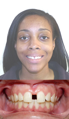 Comprehensive Treatment: Tiera presented with a Class I dental malocclusion with moderate/severe spacing in between her front teeth.  She finished with a Class I dental occlusion with all spaces relieved and proper OJ and OB.