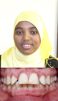 Comprehensive Treatment: Saba presented with a Class II Div I dental malocclusion with moderate protrusion of her upper incisors.  She also had moderate maxillary spacing as well as moderate mandibular crowding.  She finished with a Class I dental occlusion with all spaces consolidated and crowding relieved.