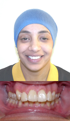 Comprehensive Treatment: Newal presented with a Class II Div I dental malocclusion.  Her upper teeth protruded ahead of her lower teeth significantly.  She also complained of a narrow smile.  She finished with a Class I dental occlusion with proper OJ and OB, a nice broad smile and her midlines now coincide.