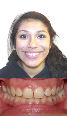 Comprehensive Treatment: Miriam presented with a Class I dental malocclusion with mild spacing in the upper arch as well as a posterior crossbite on the left side.  She finished with a Class I dental occlusion with all spaces consolidated and her crossbites corrected.