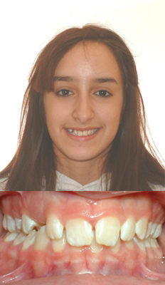 Comprehensive Treatment: Millissa presented with a severe deepbite with upper spacing as well as lower crowding.  She finished with a wonderful result with the deepbite corrected as well as all spaces consolidated and the crowding relieved.