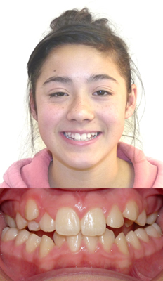 Comprehensive Treatment: Felicitas started with a Class III dental malocclusion with bilateral posterior crossbites as well as bilateral posterior open bites.  She finished with a Class I dental occlusion with all crossbites and open bites corrected.  She now has a beautiful, full smile as well as a healthy bite.