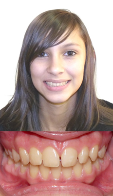 Comprehensive Treatment: Domenica presented with a Class I dental malocclusion with spacing in the upper arch as well as crowding in the lower arch.  She finished with a nicely developed Class I dental occlusion with a full smile and a healthy bite.