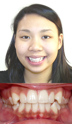 Comprehensive Treatment: Diana presented with a Class II dental malocclusion with moderate crowding in both arches.  She finished with a Class I dental occlusion with proper OJ and OB.