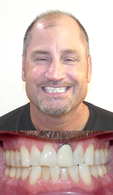 Comprehensive Treatment: Dan presented with a Class I dental malocclusion with moderate/severe crowding.  He finished with a Class I dental occlusion with all crowding relieved and the midlines now coincide.