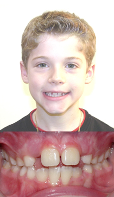 Interceptive Treatment: Gino had an open bite and insufficient space for his lateral teeth to erupt.  He began Interceptive treatment and was given a palatal expander and a lower expander.  This allowed both arches to develop and to allow sufficient space for the permanent teeth to erupt and to assist in closing his bite.