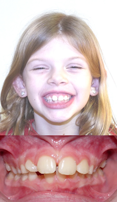 Interceptive Treatment: Gianna underwent Interceptive treatment with an upper and lower expander in order to develop both arches and to alleviate crowding as well as to allow sufficient space for the permanents to erupt. No braces were used.