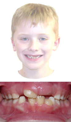 Interceptive Treatment: Elliot presented with moderate crowding in both arches. The insufficient space resulted in preventing his permanent teeth from erupting.  He underwent Interceptive treatment with a palatal expander as well as a lower expander in order to create space for the permanent teeth to erupt. Braces were not used in this case.