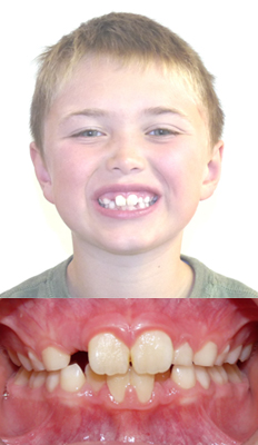 Interceptive Treatment: Declan presented with moderate crowding in both arches as well as a narrow smile. He underwent Interceptive treatment and was given a palatal expander as well as a lower expander. This allowed sufficient space for the permanents to erupt and for his arches to naturally develop into a full broad smile. Braces were not used in this case.