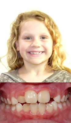 Interceptive Treatment: Camryn initially presented with moderate crowding. She underwent Interceptive treatment with an upper palatal expander as well as a lower expander to assist in accommodating the permanent teeth. Braces were not used in this case.