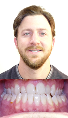 Orthognathic/Jaw Surgery: Mike had a Class III dental malocclusion with an anterior and posterior crossbite.  He underwent Orthognathic Surgery (maxillary advancement) in order to correct the crossbites as well as his mid-face deficiency. He finished with a Class I dental occlusion and he shows significantly more incisor display upon smiling.